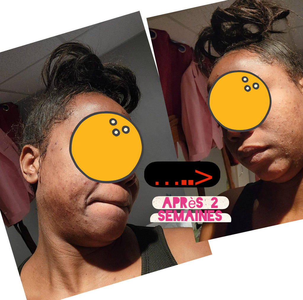 Gamme Chasseur d’acné