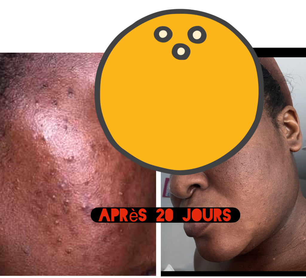 Gamme Chasseur d’acné