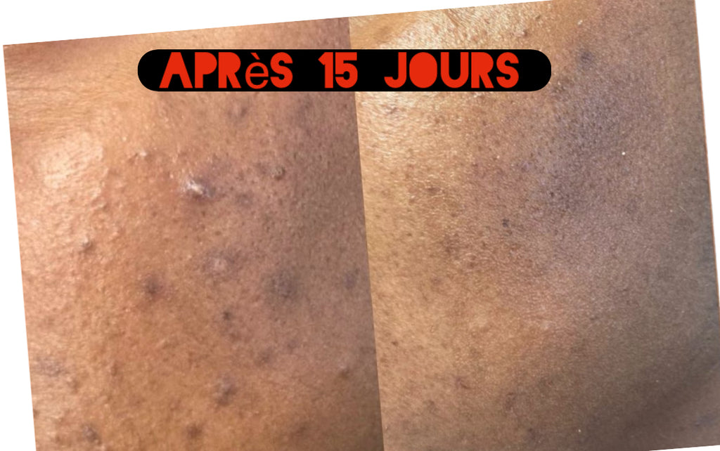 Gamme Chasseur d’acné