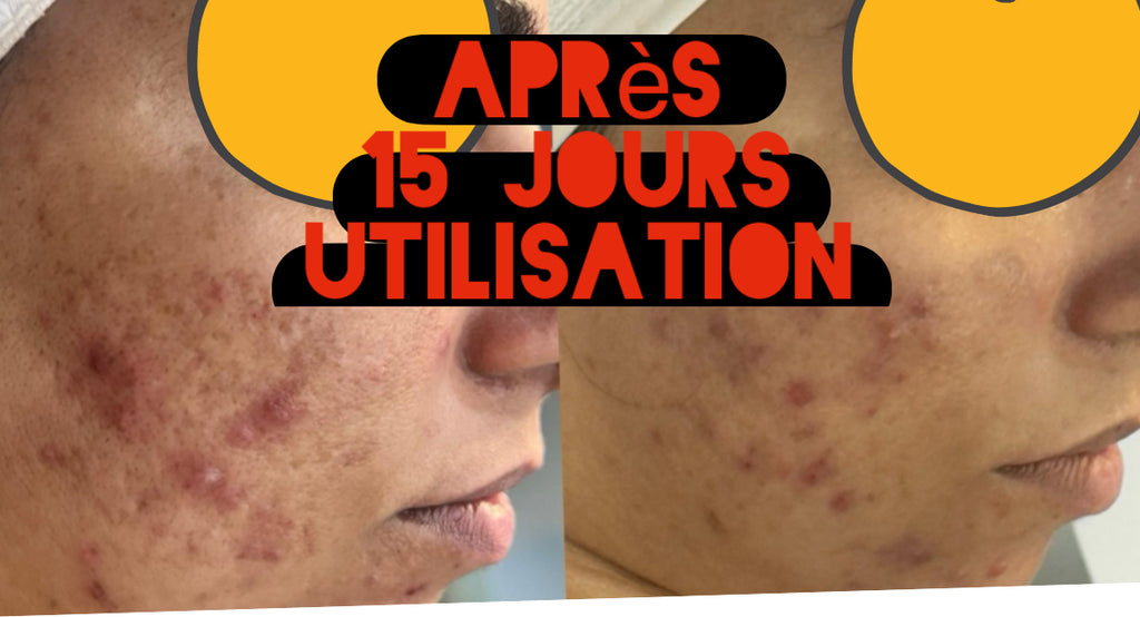 Gamme Chasseur d’acné