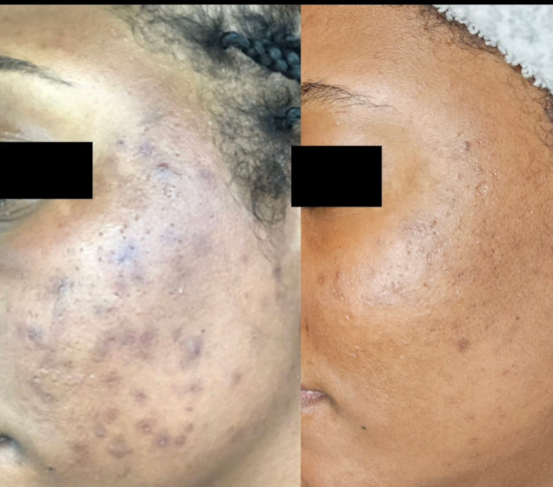 Gamme Chasseur d’acné